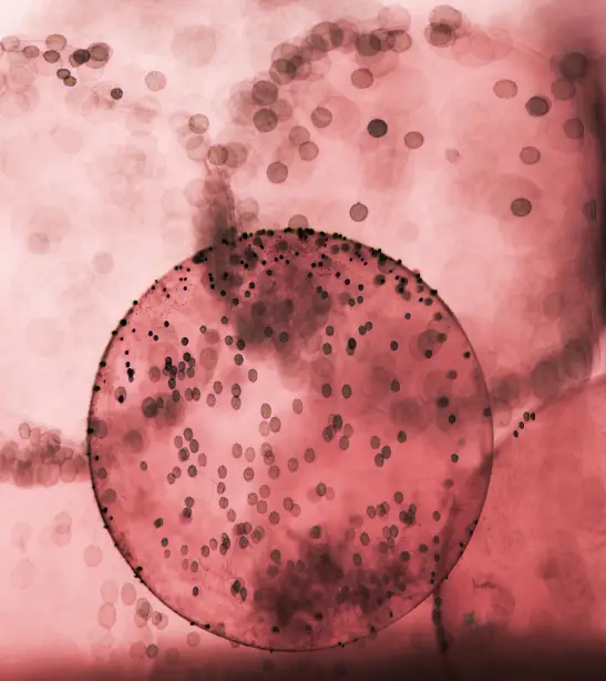 ما هو الورم النقوي المتعدد ؟